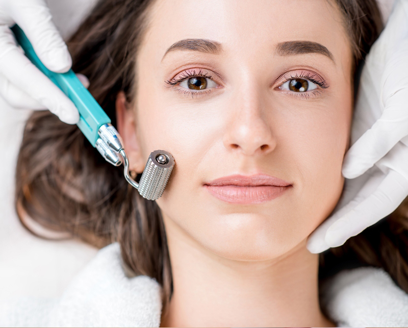 microneedling
